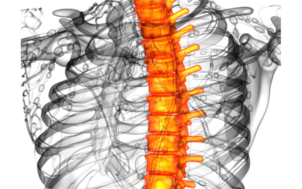 Scoliosi: nuova tecnica che elimina il busto e riallinea la colonna vertebrale