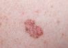 Battipaglia. Arriva l’estate: i consigli per proteggere la pelle, intervista al dermatologo Landi (video)